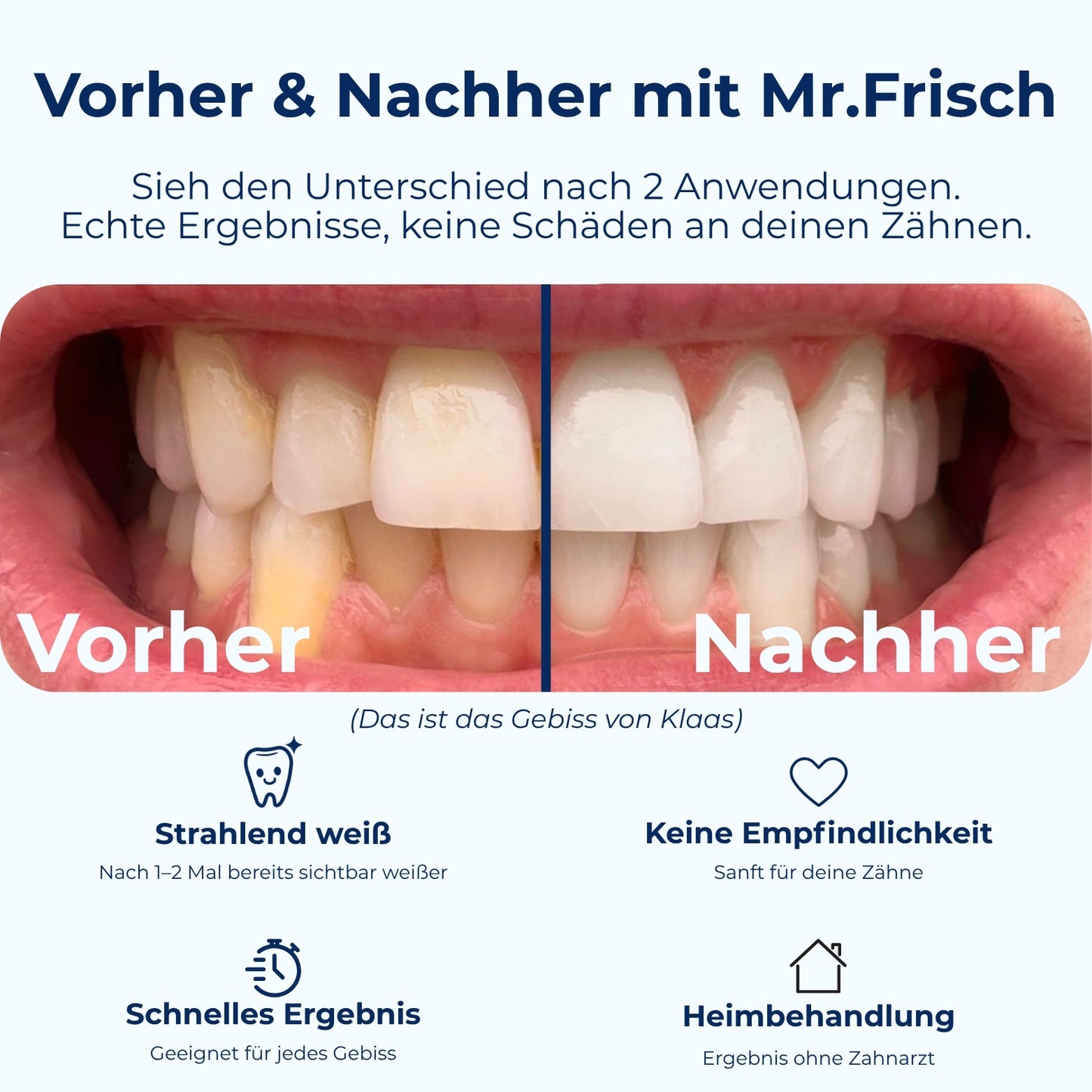 Mr.Frisch Bleaching Schienen