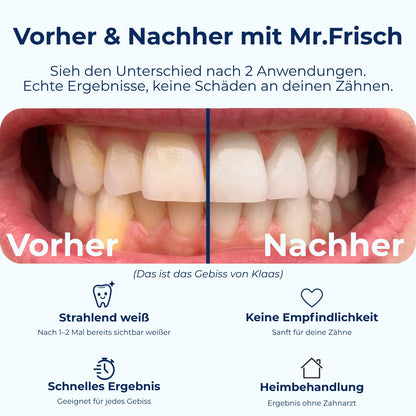 Mr.Frisch Bleaching Schienen